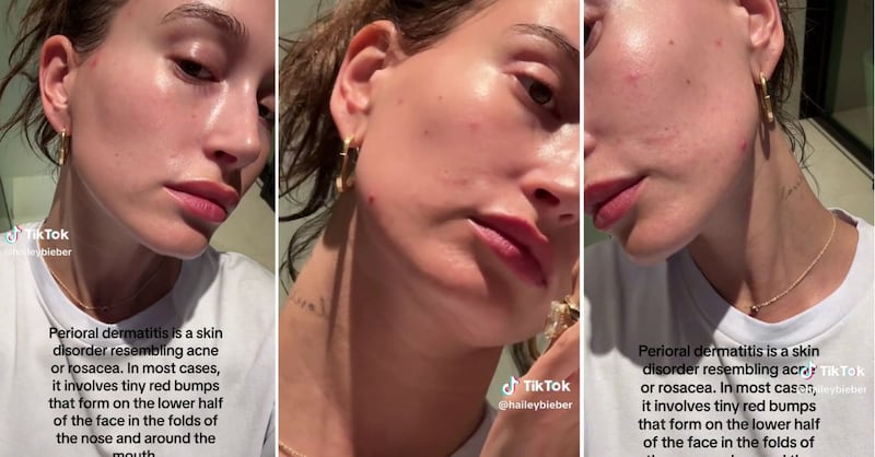 Hailey Bieber se sinceró con sus seguidores sobre su experiencia con la dermatitis perioral