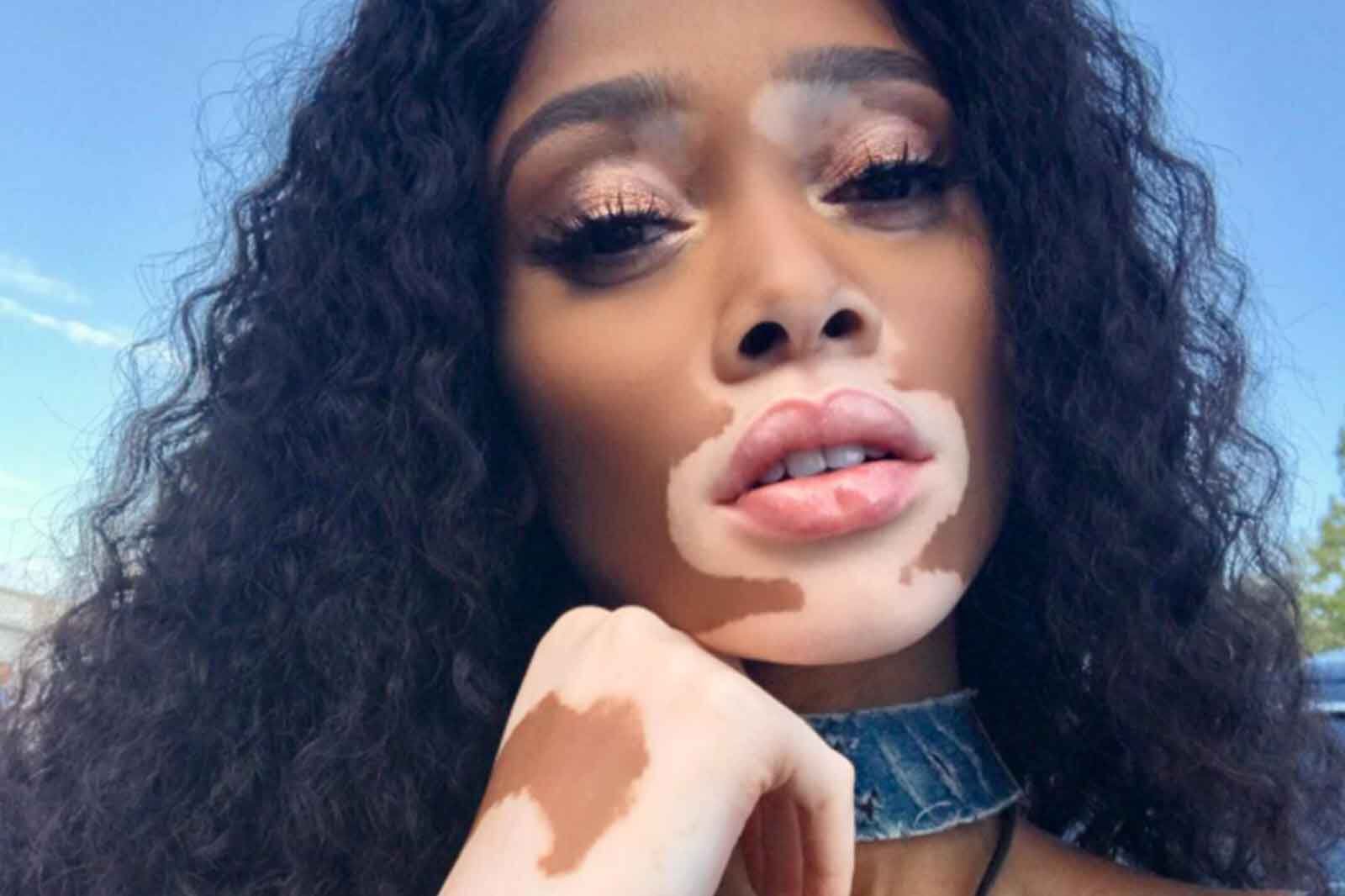 Winnie Harlow, modelo con vitiligo, se desnuda en Instagram